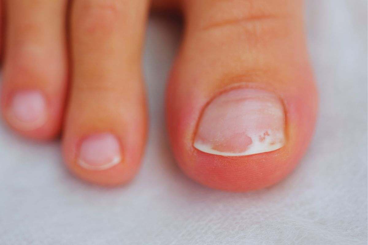 Unghia alluce malata
